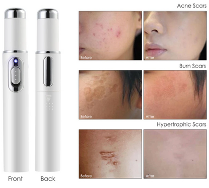 NUEVO LÁPIZ LÁSER PARA ELIMINAR MANCHAS O ACN